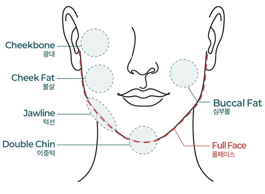 WonderFit injection facial treatment areas