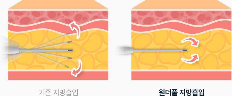 바디 지방흡입 주변조직 손상 최소화 전용캐뉼라 삽입