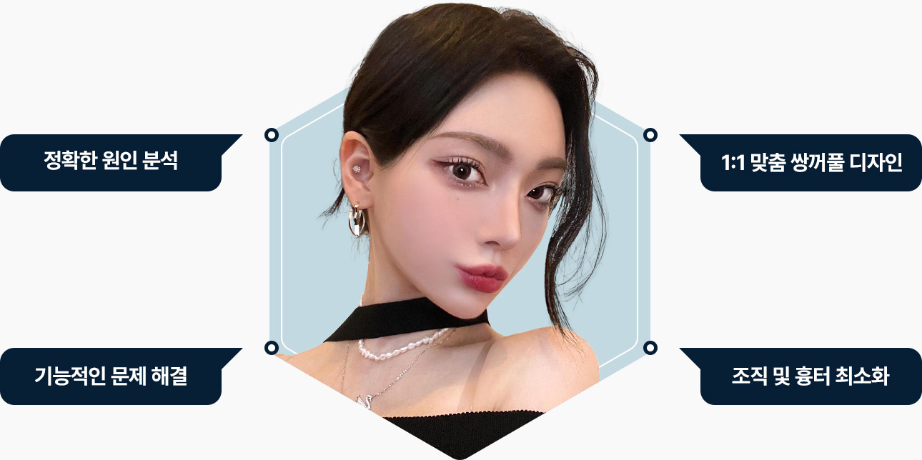 맞춤 쌍꺼풀 기능문제 해결 조직 흉터 최소화