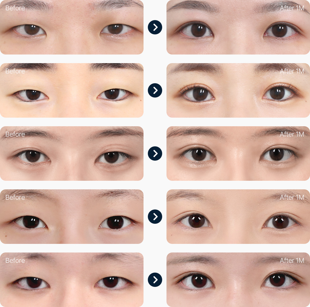 눈매교정 전후사진