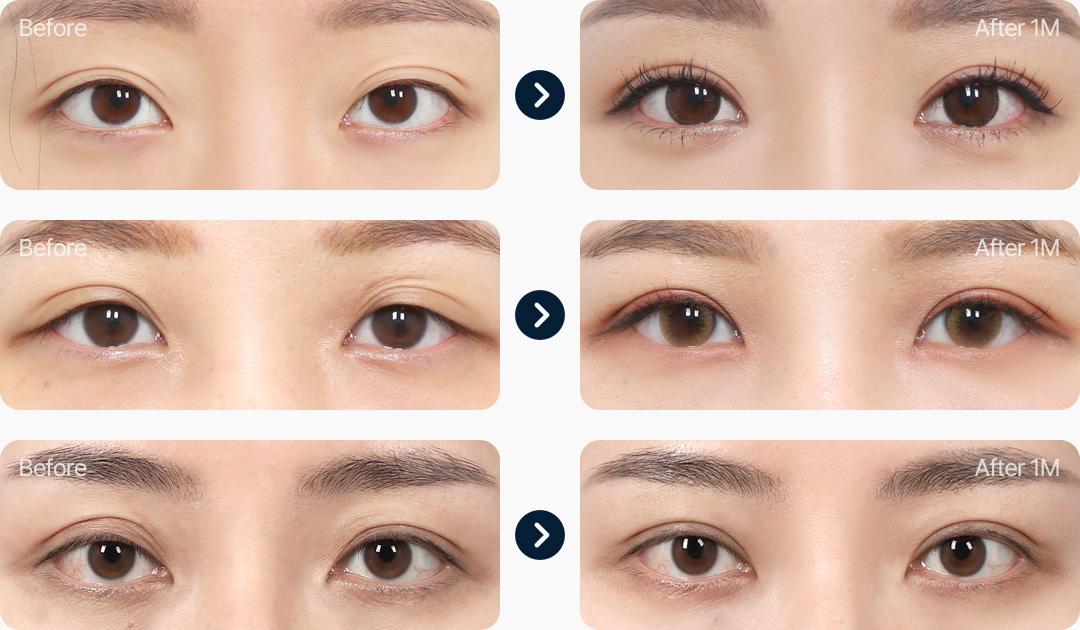 라인낮추기 전후사진