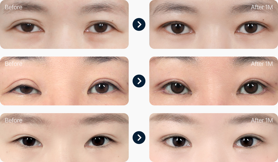 라인낮추기 전후사진