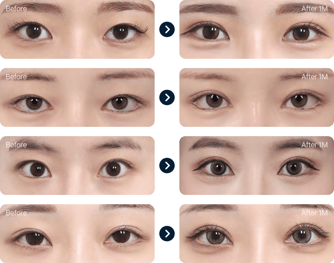 눈재수술 전후사진