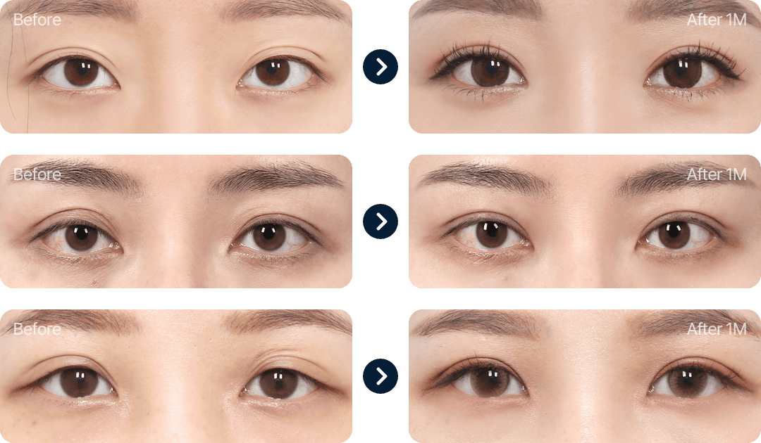 눈재수술 전후사진