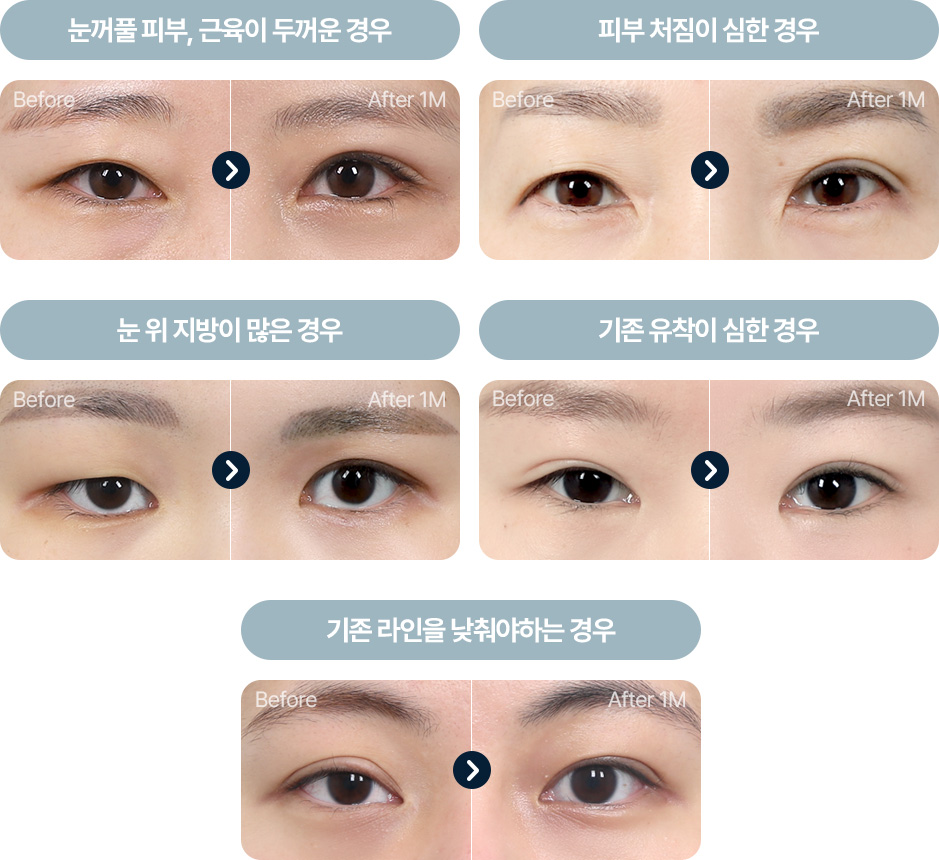 원더풀 완전절개 피부 근육이 두꺼운 경우 피부 처짐 눈위 지방이 많은경우 기존 유착이 심한경우 기존 라인을 낮추는 경우