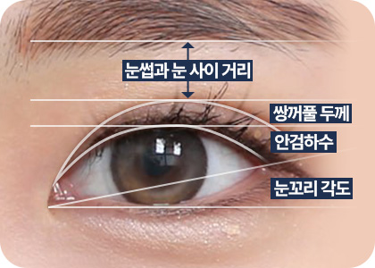 원더풀 완전절개 눈썹과 눈 사이 거리 쌍꺼풀 두께 안검하수 눈꼬리 각도