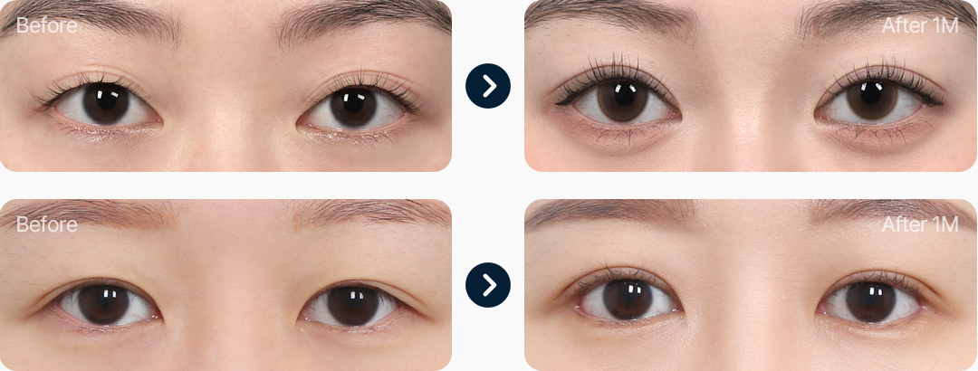 자연유착 전후사진