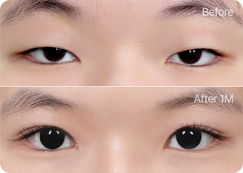 원더풀 부분절개 지방제거 윗트임