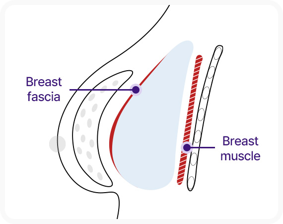 근막하 보형물 삽입 가슴근육막 가슴근육 사이
