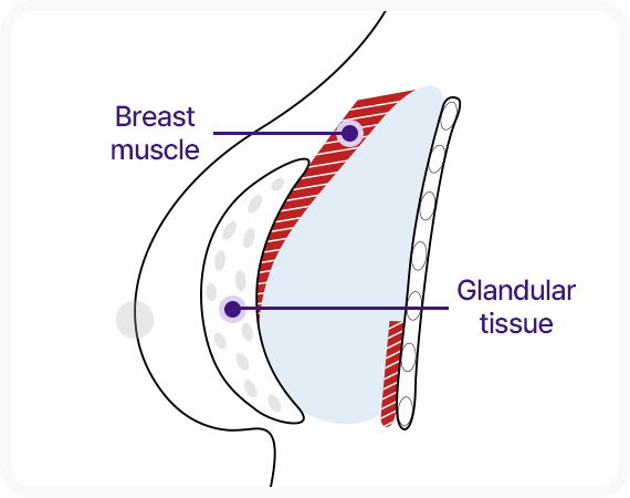 이중평면 보형물 삽입 가슴급육 아래 박리 유선조직 위