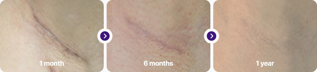 겨드랑이 절개 후기 1개월차 6개월차 1년차