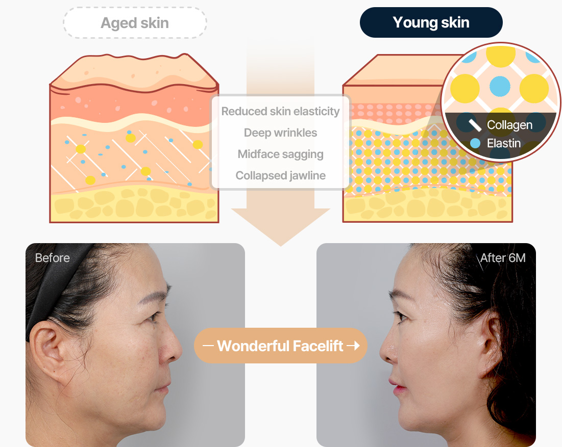 안면거상 노화 진행된 피부 피부탄력저하 깊은주름 중안면부처짐 무너진턱선 원더풀 안면거상 전후사진 안면거상 수술후기