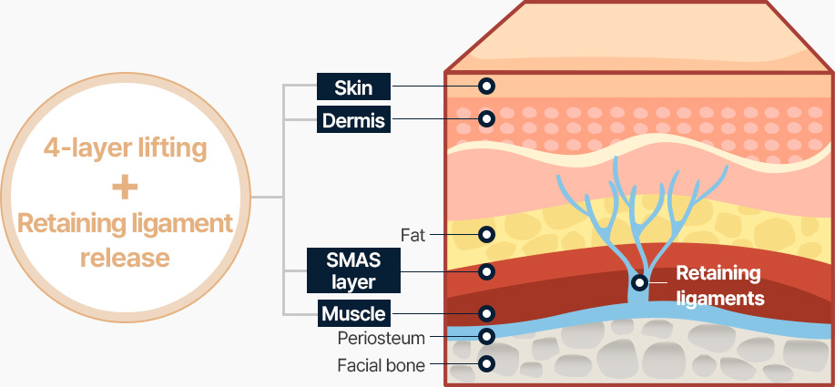 안면거상 4중리프팅 늘어진 유지인대 끊기 피부 진피 근막 근육층 4중으로 당겨 리프팅