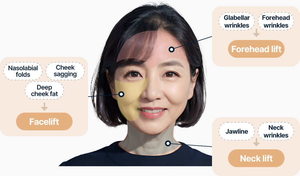 팔자주름 볼처짐 심부볼 안면거상으로 개선 미간주름 이마주름 이마거상으로 개선 턱선 목주름 목거상으로 개선