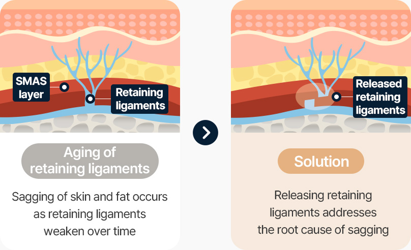 안면거상 근막 유지인대 노화 피부와 지방처짐발생 유지인대를 절제 피부처짐 원인 해결