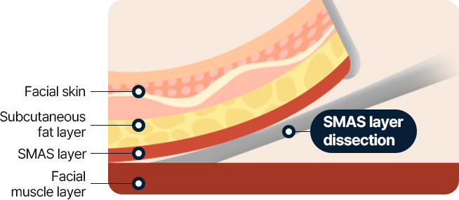안면거상 안면피부 피하지방층 근막 얼굴근육층 근막층 박리