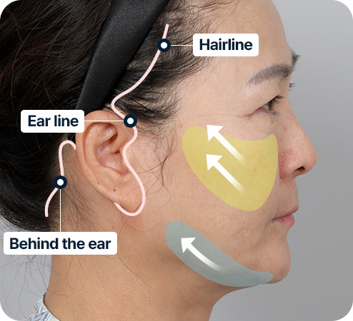 안면거상 섬세한 봉합 흉터 최소화 수술전 7일후 3개월후 6개월후 흉터최소