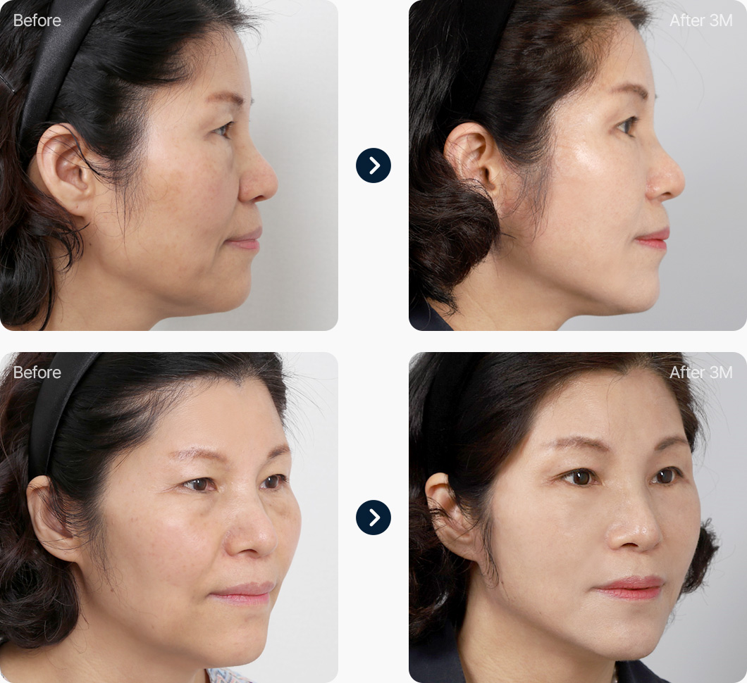 안면거상 전후사진 안면거상후기