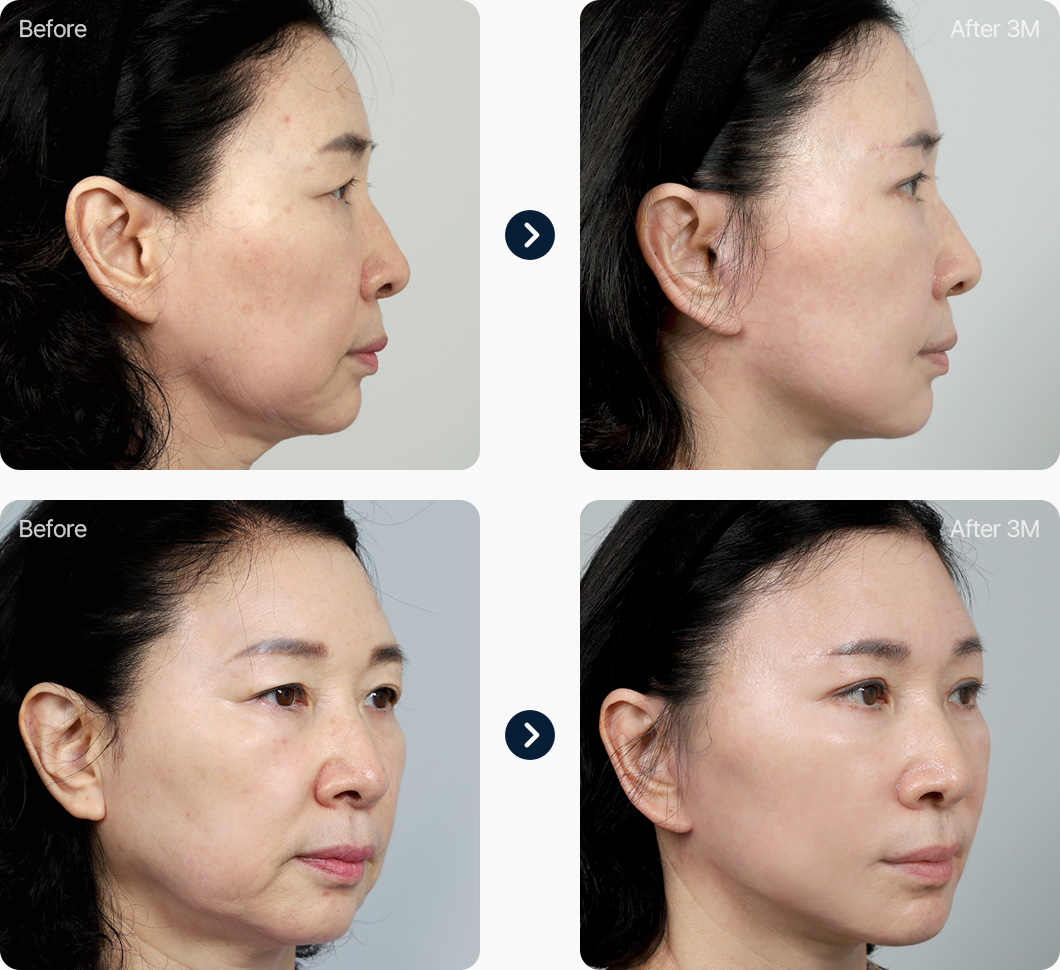 안면거상 전후사진 안면거상후기