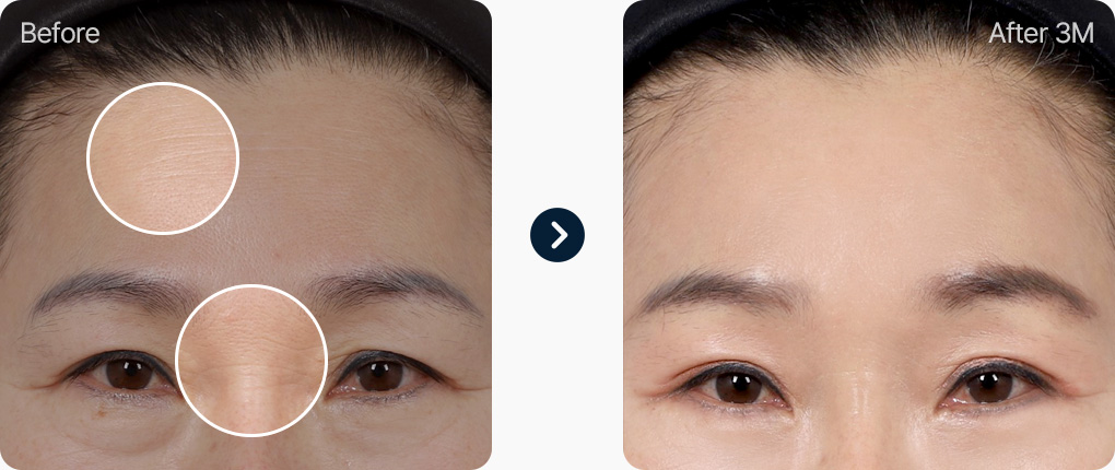 이마거상 전후사진 이마거상후기 이마주름 미간주름 눈썹처짐 개선