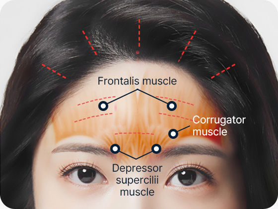 이마거상 전두근 추미근 눈썹내림근 섬세한 절개 및 박리 