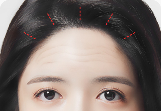 이마거상 수술방법 헤어라인 안쪽 눈썹 위치 처짐정도에 따라 맞춤 최소절개