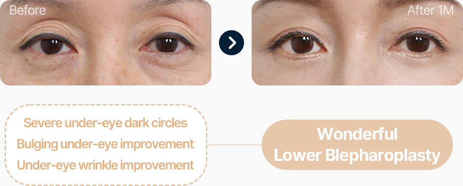 하안검 전후사진 하안검 수술후기 눈밑 다크서클 불룩한 눈밑 눈밑주름 개선 원더풀 하안검