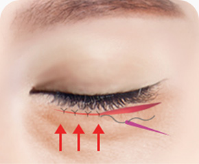 늘어진근육 뒤로당겨 고정 주름을 펴 섬세한 봉합