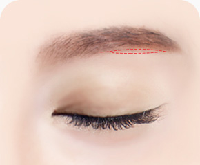 눈썹하거상술 방법 눈썹아래 라인 최소절개 늘어진 피부 불필요한 지방 제거