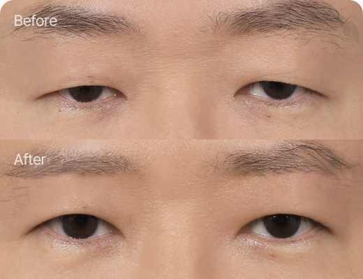 눈썹하거상술 전후사진 눈썹하거상술후기