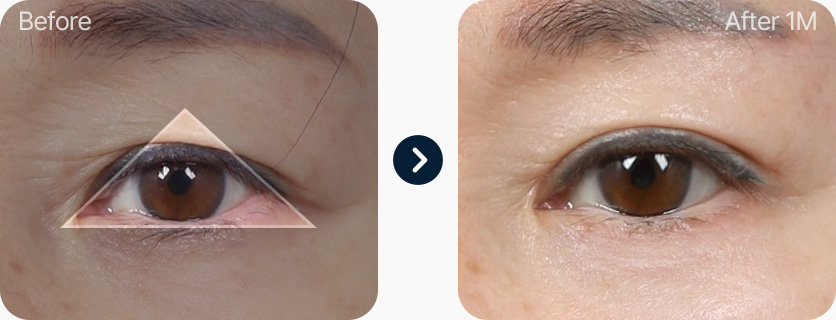 상안검 전후사진 중년상안검 상안검후기