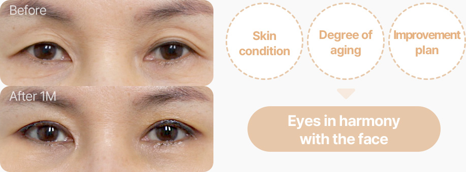 상안검 전후사진 중년상안검 상안검후기 피부상태 노화정도 개선방안 고려한 디자인 얼굴과 조화로운 눈