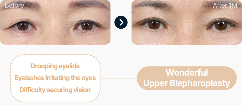 상안검 전후사진 중년상안검 상안검후기 눈꺼풀처짐 속눈썹이 눈을 찌름 시야확보 어려움