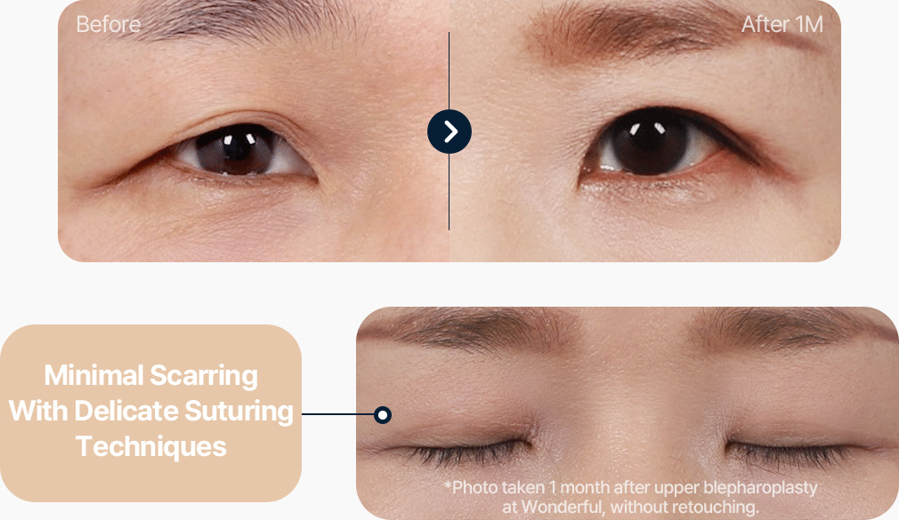 상안검 전후사진 중년상안검 상안검후기 섬세한 봉합기술로 흉터 최소화