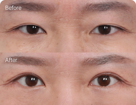 상안검 전후사진 상안검 후기