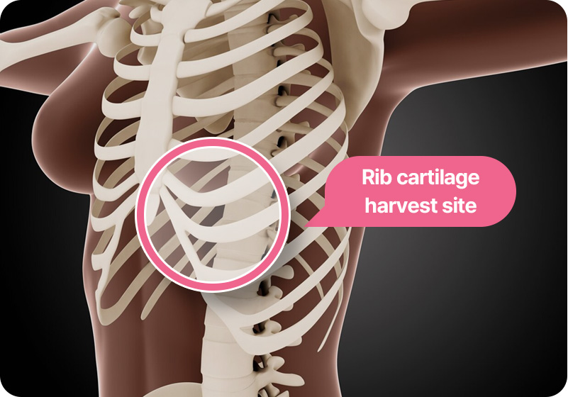 늑연골 채취 부위 갈비뼈 아래위치