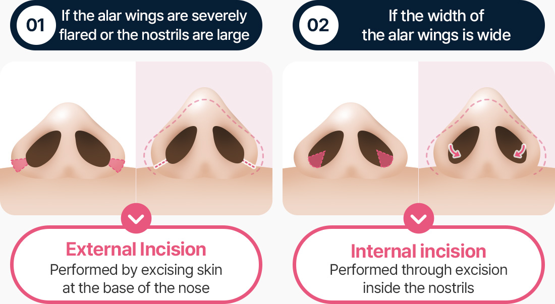 심하게 퍼진 콧날개 큰 콧구멍 외측절개 코 바닥 피부 절제 폭 넓은 콧날개 내측 절개 코 안쪽 절제