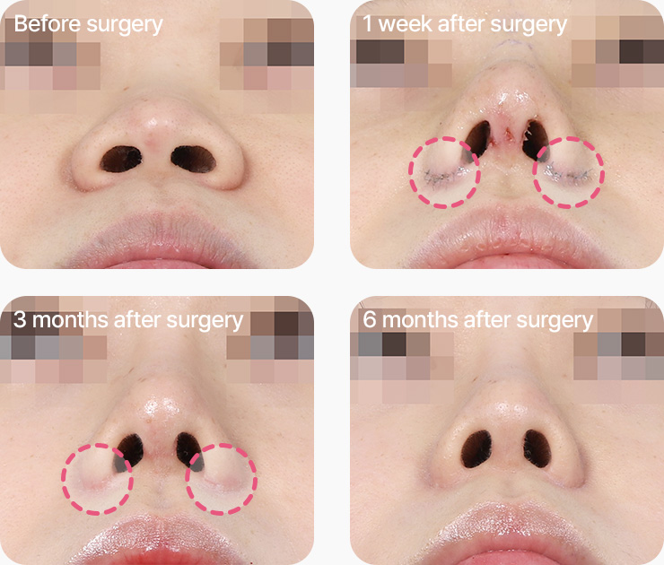 콧볼축소 흉터 경과 수술 1주차 3개월차 6개월차