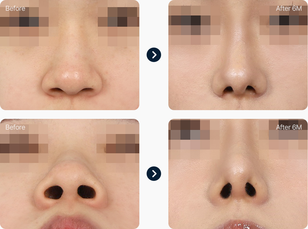 콧볼축소 수술 전후사진