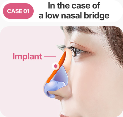 콧대가 낮은경우 보형물 낮은코성형