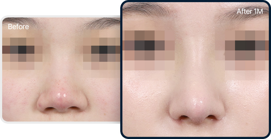 복코 성형 전후사진