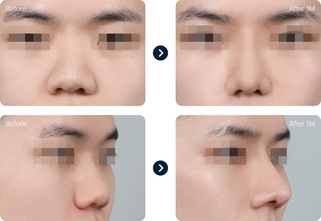 복코 성형 전후사진