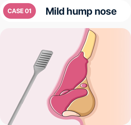 심하지 않은 매부리코