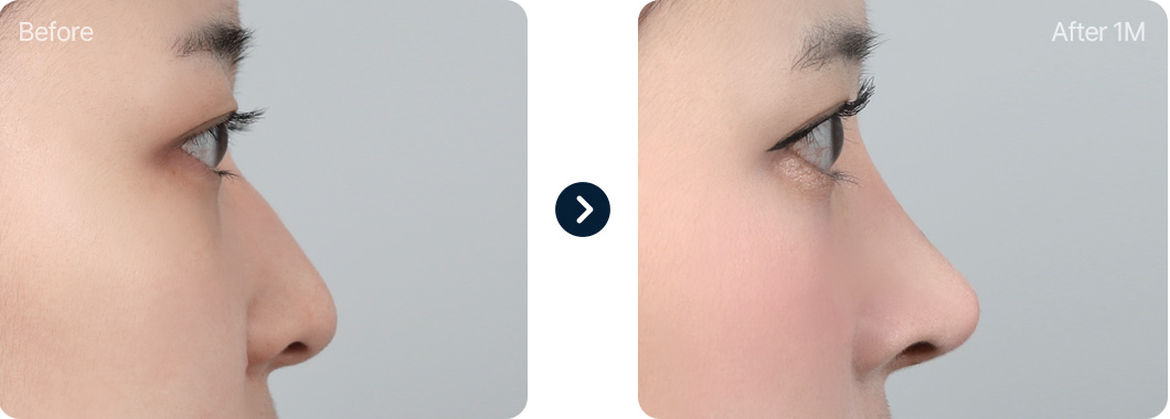 매부리코 성형 전후사진