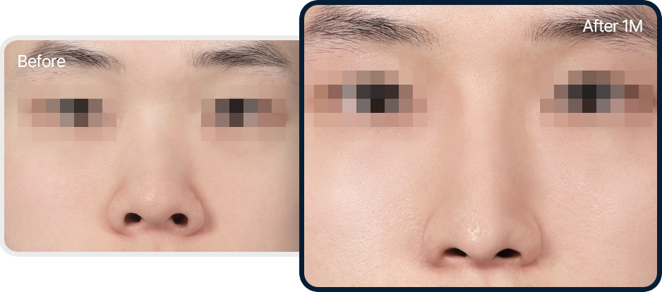 들창코 성형 전후사진