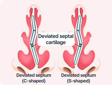 짧은코 들창코 수술 자가연골 비중격 연장