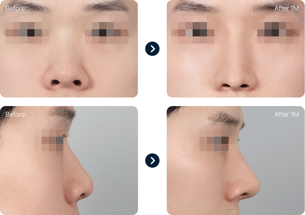 짧은코 들창코 성형 전후사진