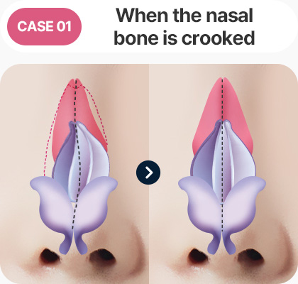 화살코 긴코 수술방법 보형물