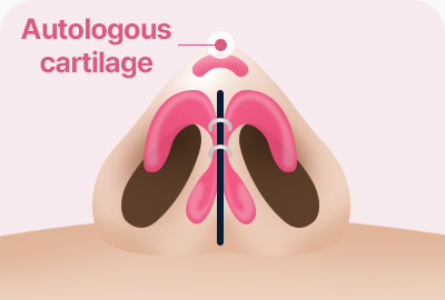 휘어진 비중격 연골 비중격 만곡증 C형 S형