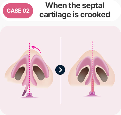 비중격 연골이 휘어진 경우